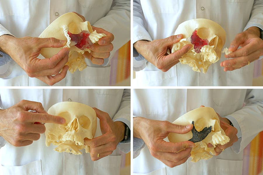 A man with a skull in his hands, a replacement zygomatic bone has been 3d printed and fitted to it